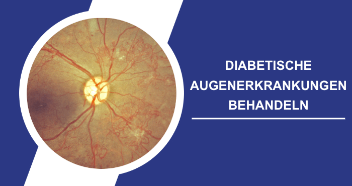 Behandlung diabetischer Augenerkrankungen Titelbild