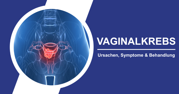 Vaginalkrebs Ursachen Symptome Behandlung Titelbild